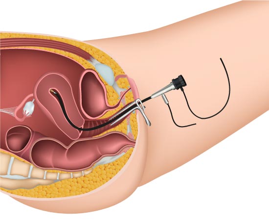 頚 ポリープ 子宮 管 子宮頸管ポリープは切除が必要？再発や妊娠中の治療について解説！